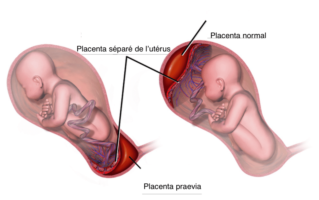 placenta praevia cest quoi